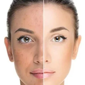 The Skin Lab Pro TCA Skin Peel